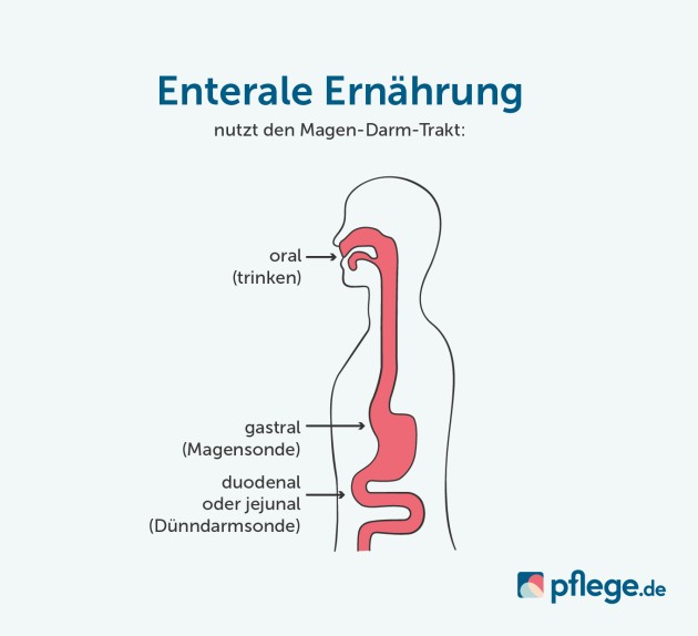 Enterale Ernährung nutzt den Magen-Darm-Trakt