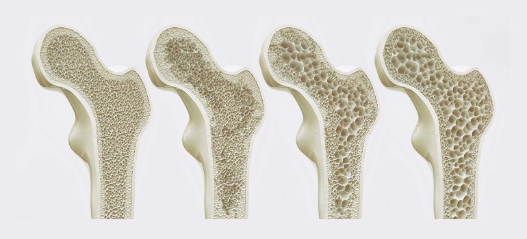 Osteoporose Diagnose