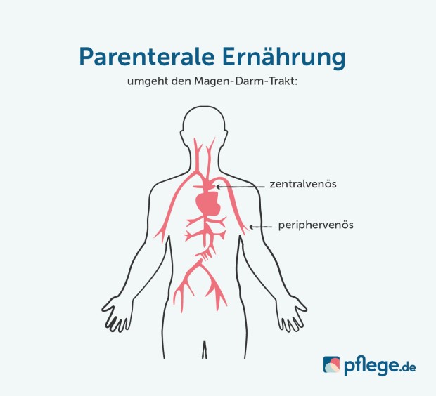 Grafik Parenterale Ernährung