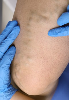 Warnvenen auf einem Oberschenkel