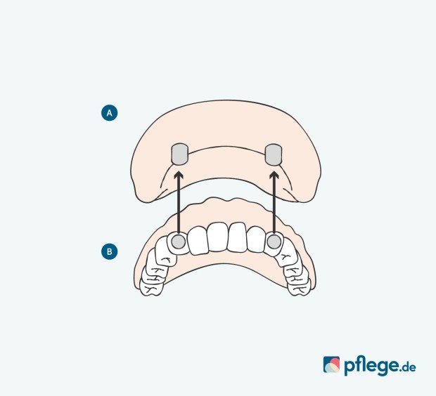 Zahnersatz Deckprothese