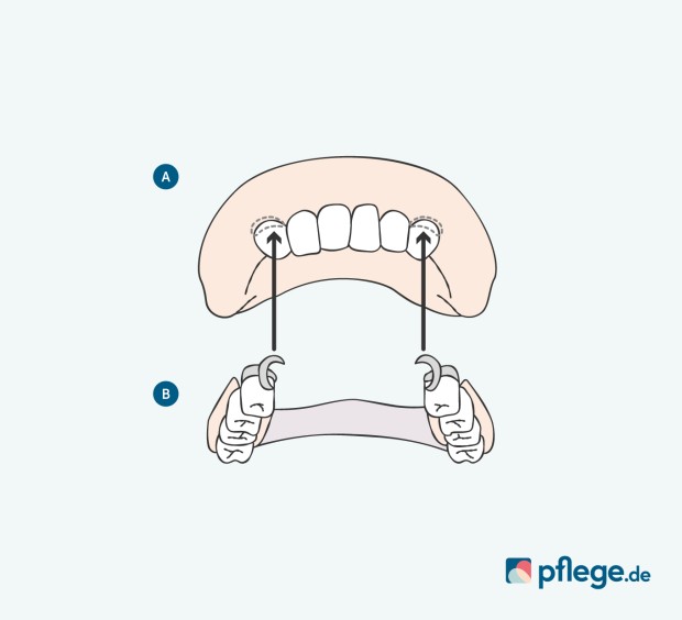 Zahnersatz Klammerprothese