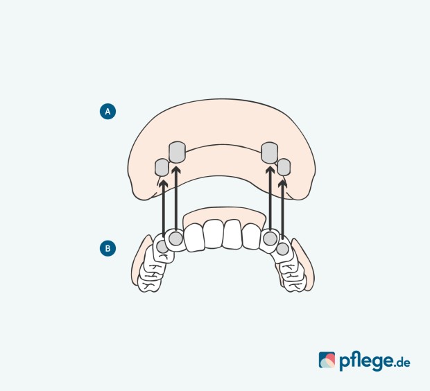 Zahnersatz Teleskopprothese