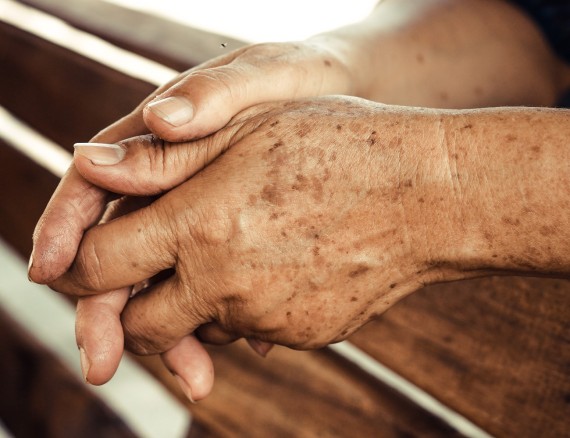 Altersflecken auf der Haut