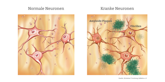 Alzheimer Neuronen