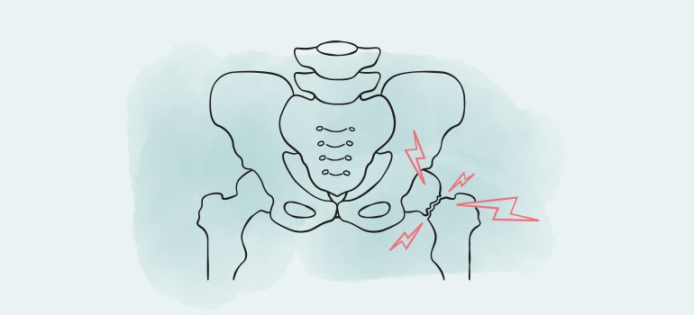 Oberschenkelhalsbruch
