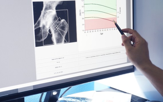 Osteoporose Knochendichtemessung Bild