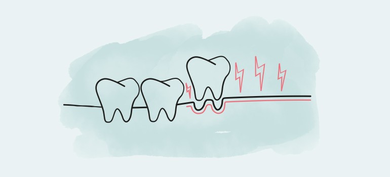 Paradontose, Paradontitis