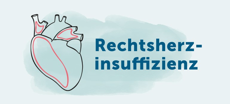 Rechtsherzinsuffizienz (Rechtsherzschwäche)