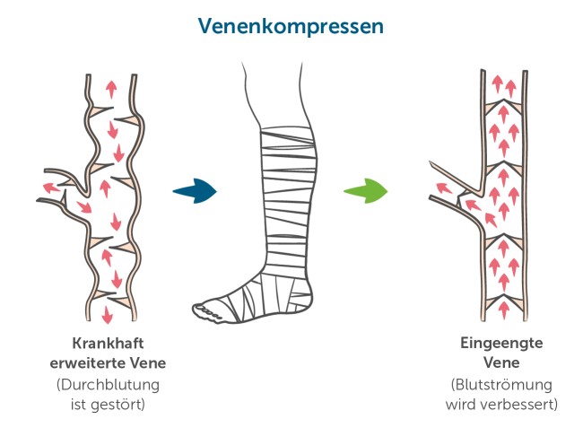 Venenkompression bei Ulcus cruris