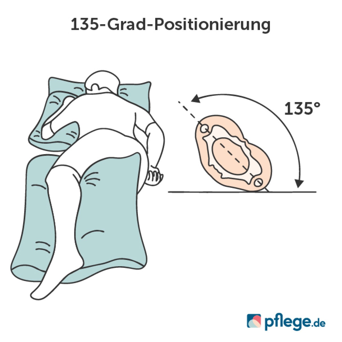 135-Grad-Positionierung bei Dekubitus