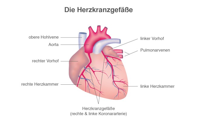Herzinfarkt: Verstopfte Herzkranzgefäße