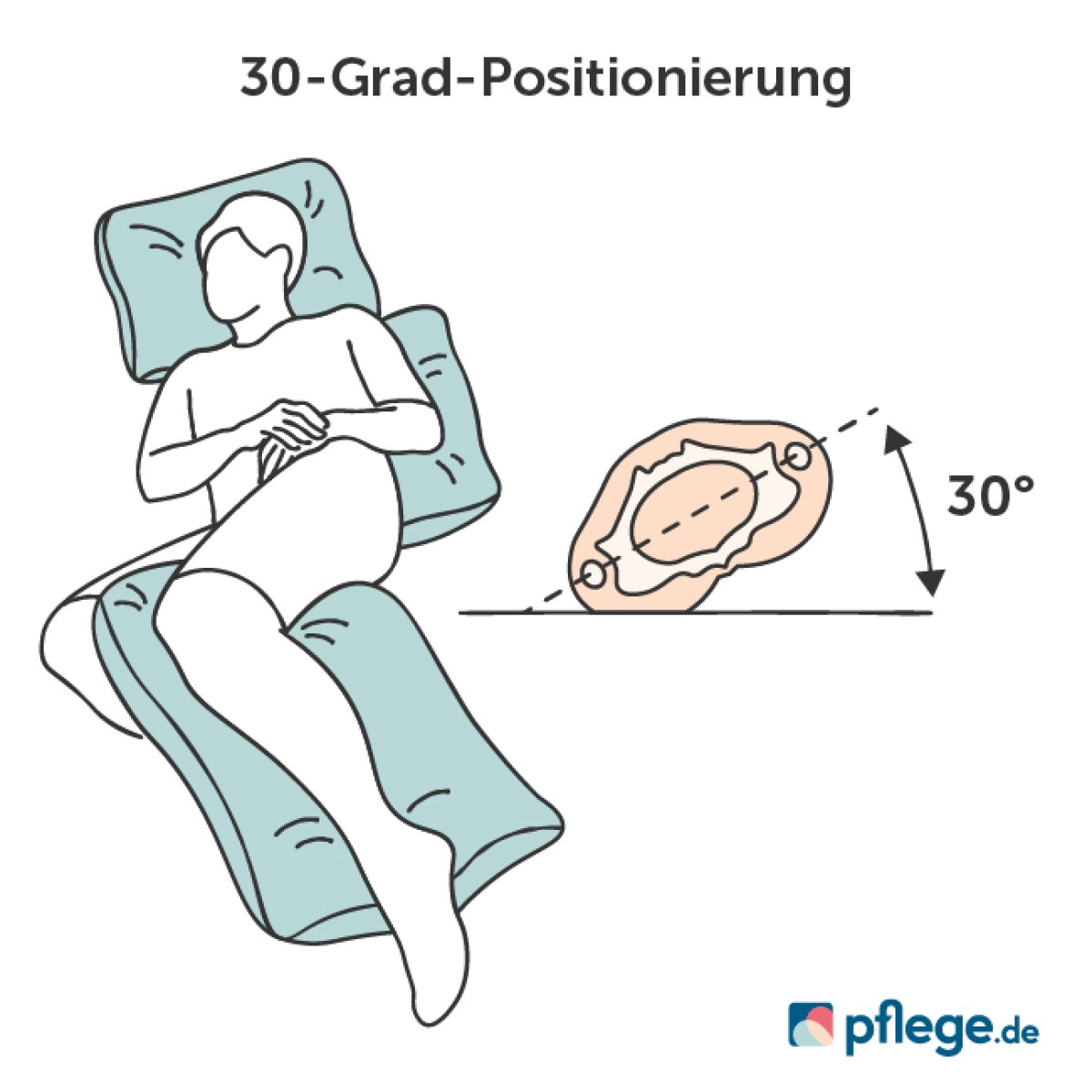 30-Grad-Positionierung bei Dekubitus