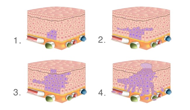 Tumorentstehung bei Krebs