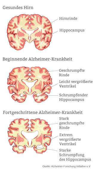Alzheimer Demenz Ursachen