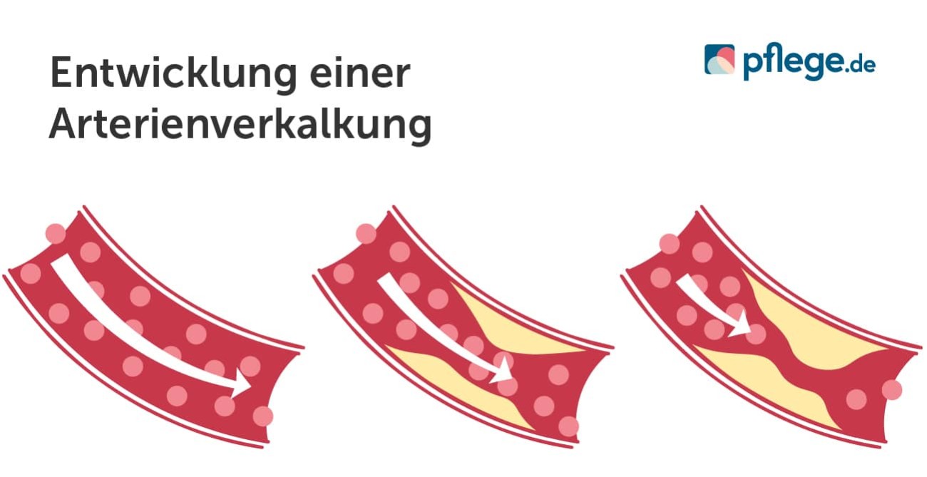 Entwicklung einer Arterienverkalkung