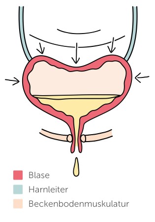 Belastungsinkontinenz (Stressinkontinenz)