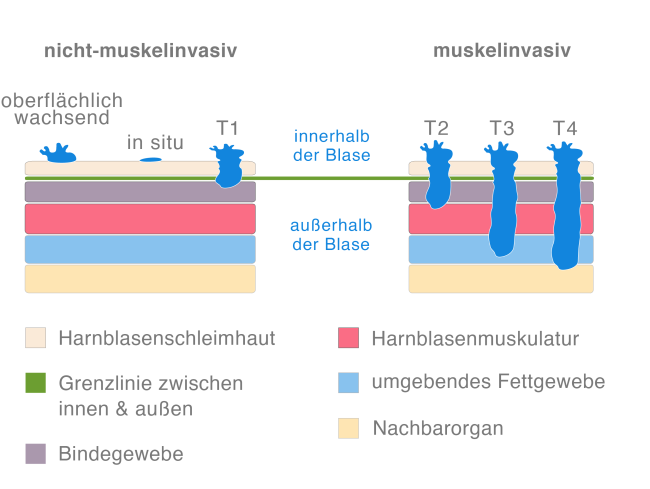 Arten von Blasenkrebs