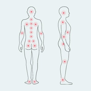 Allgemeine Prädilektionsstellen für Dekubitus