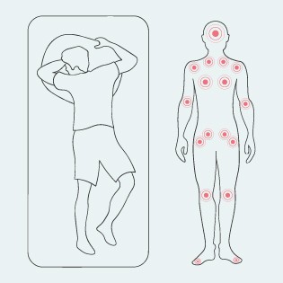 Prädilektionsstellen für Dekubitus in Bauchlage