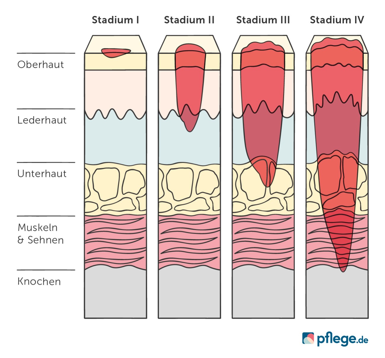 Dekubitus-Stadien und Hautschichten