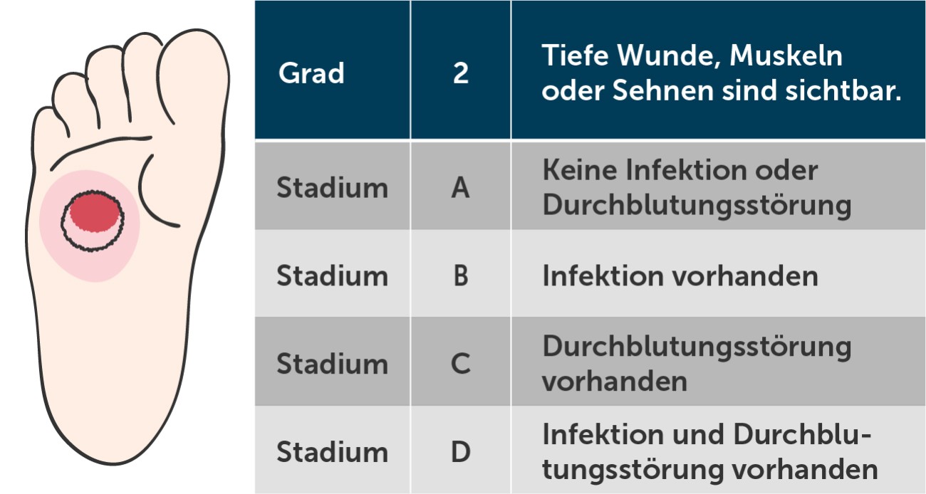 Diabetischer Fuß Wagner-Grad 2