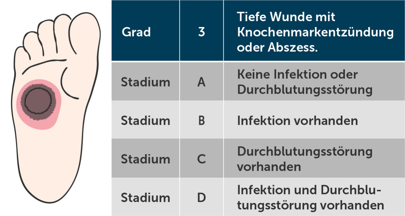 Diabetischer Fuß Wagner-Grad 3