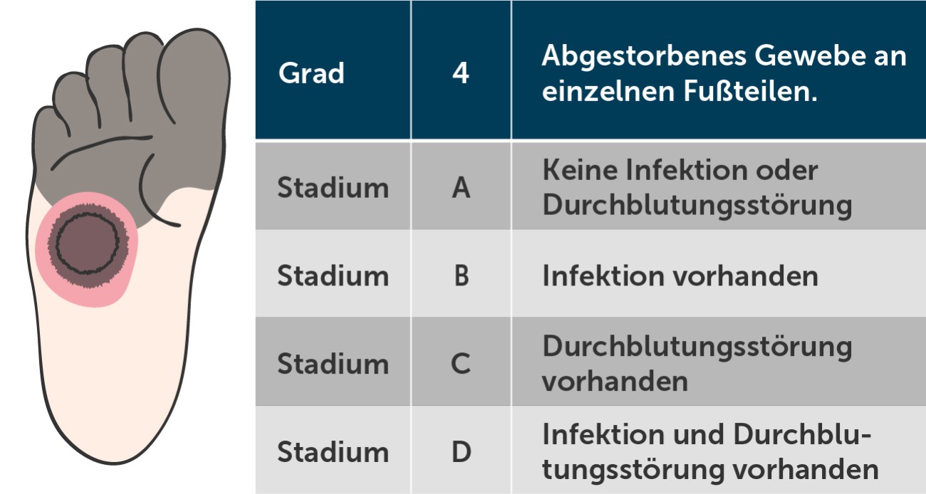 Diabetischer Fuß Wagner-Grad 4