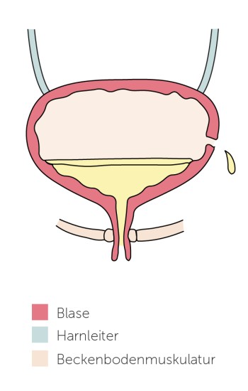 Extraurethrale Inkontinenz