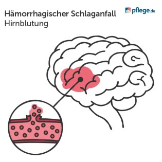 Hämorrhagischer Schlaganfall