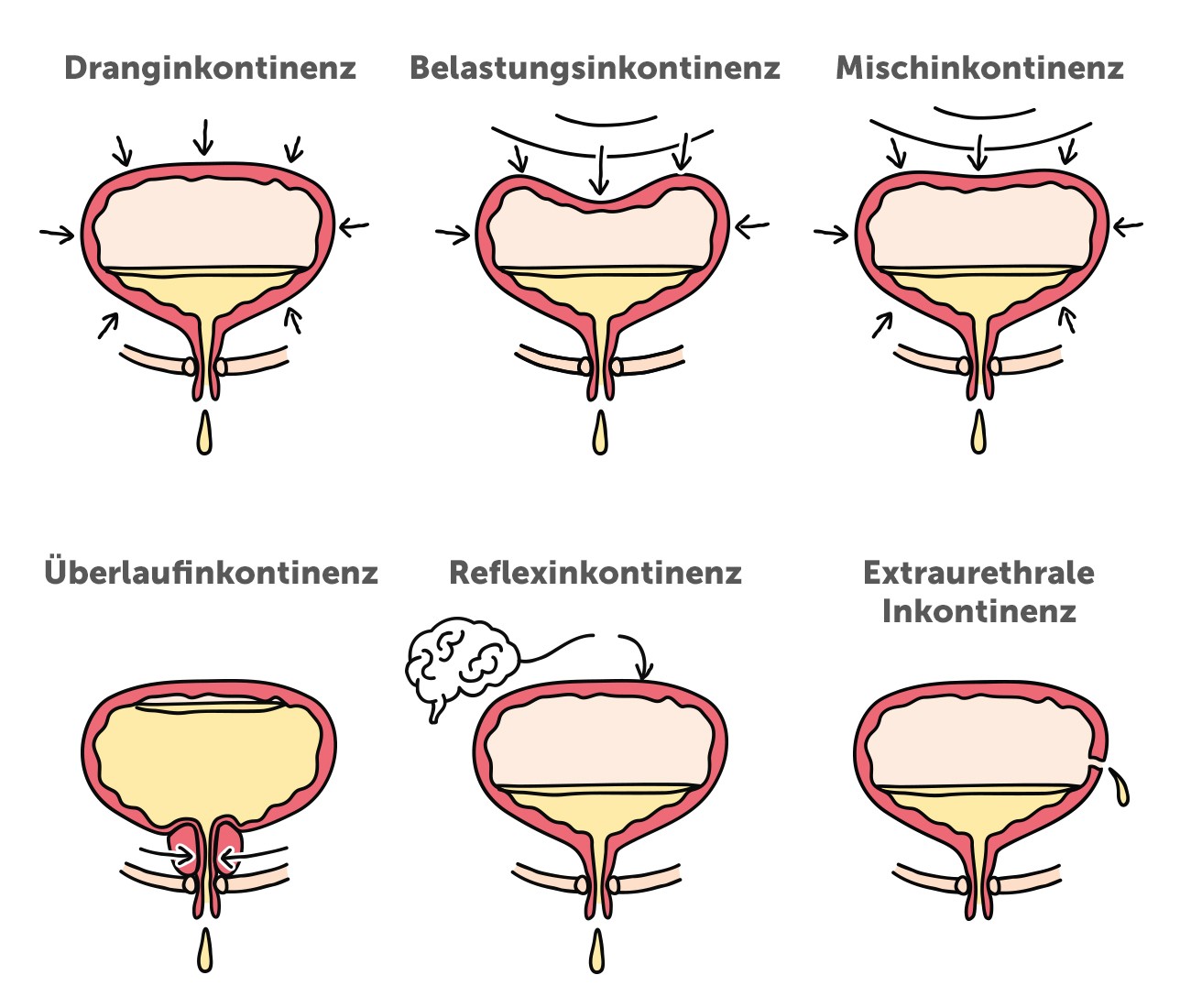Harninkontinenz-Formen im Überblick