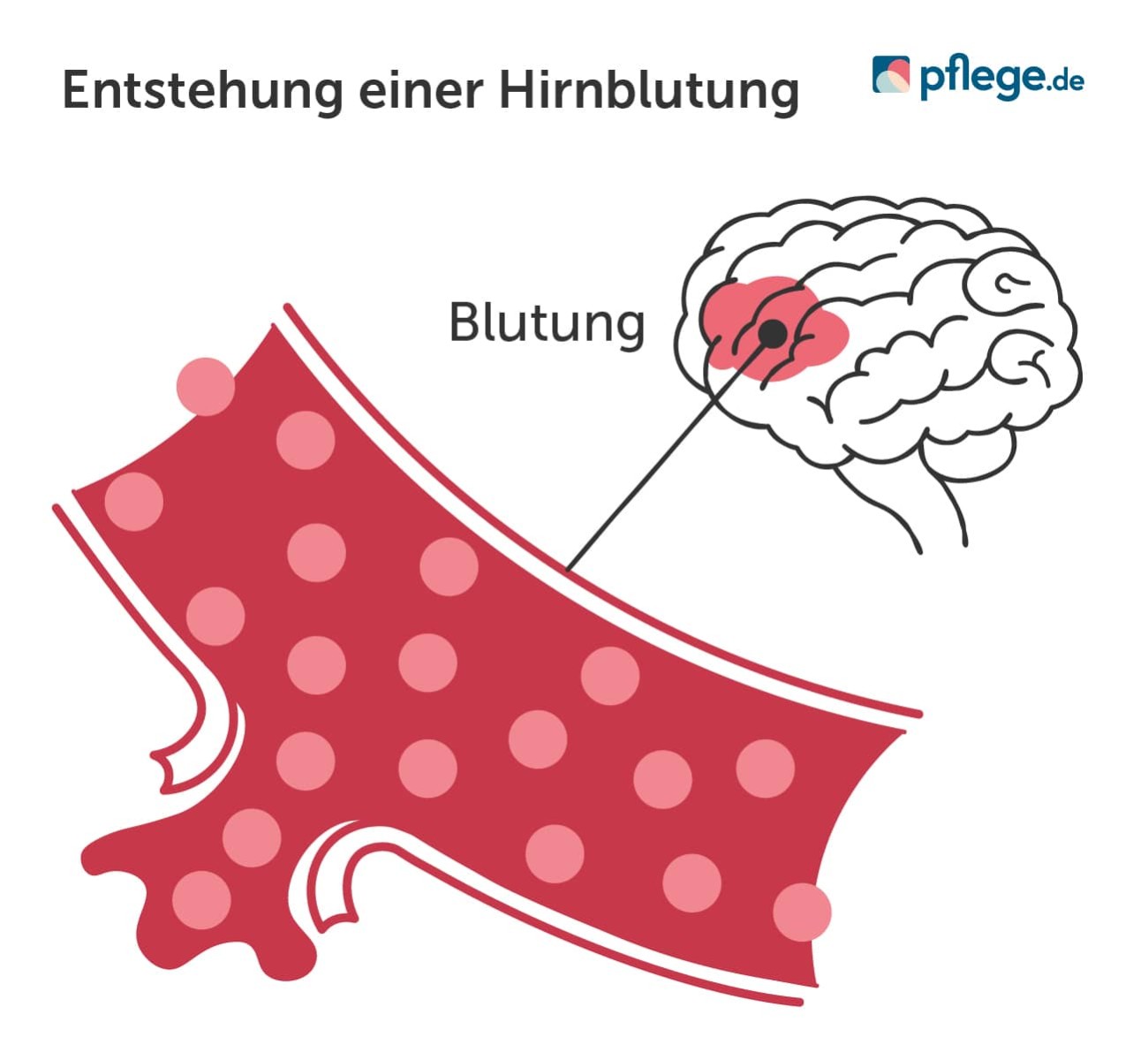 Entstehung einer Hirnblutung