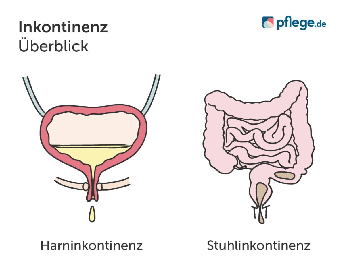 Inkontinenz-Formen