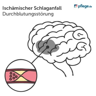Ischämischer Schlaganfall