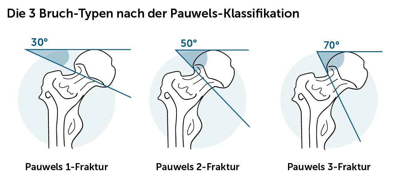 Oberschenkelhalsbruch Pauwels-Klassifikation
