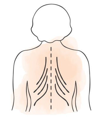 Tannenbaumphänomen bei Osteoporose