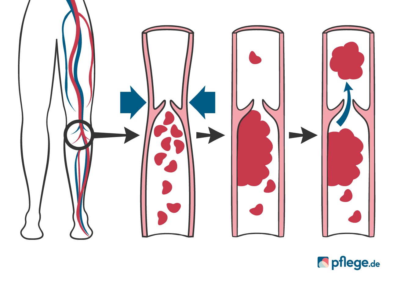 Thrombus Infografik