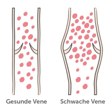 Gesunde und schwache Vene