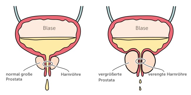 Normale und vergrößerte Prostata im Vergleich