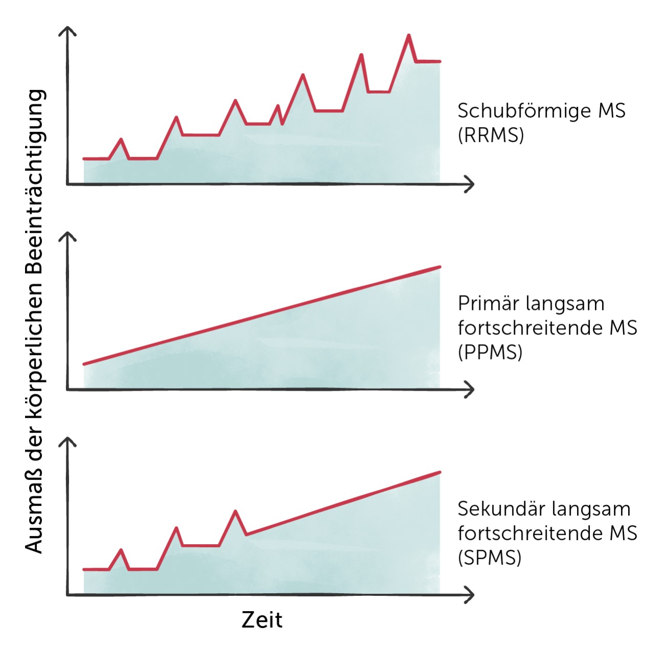 Verlaufsformen bei Multipler Sklerose (MS)