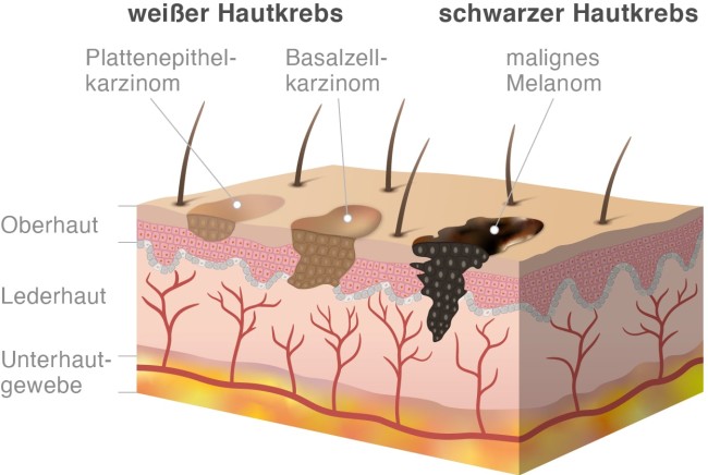 Infografik: Weißer Hautkrebs und schwarzer Hautkrebs im Vergleich