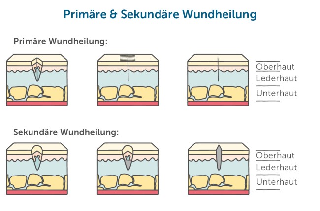 Primäre und sekundäre Wundheilung