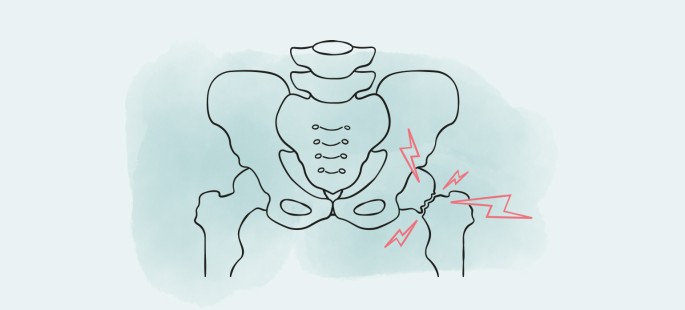 Oberschenkelhalsbruch